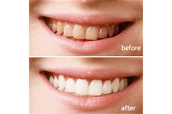 矯正牙齒最早需要多久,做牙齒矯正一般需要多久?