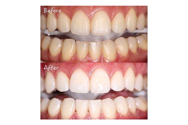 牙齒美白能持續多久