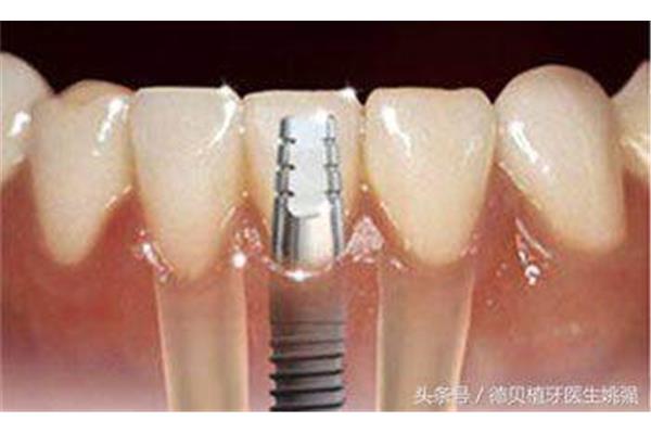 種植牙后幾天牙齦就能長好,種植牙后幾天牙齦就會腫脹