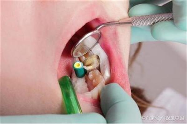 銀補牙可以用多久,汞補牙多久會脫落?
