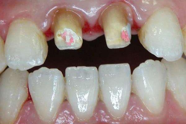 牙齒脫落后裝假牙多久,拔牙后裝假牙多久?