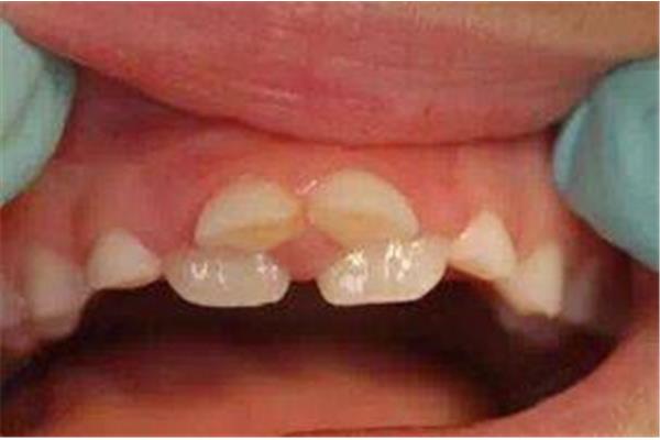 雙排牙乳牙多久會掉