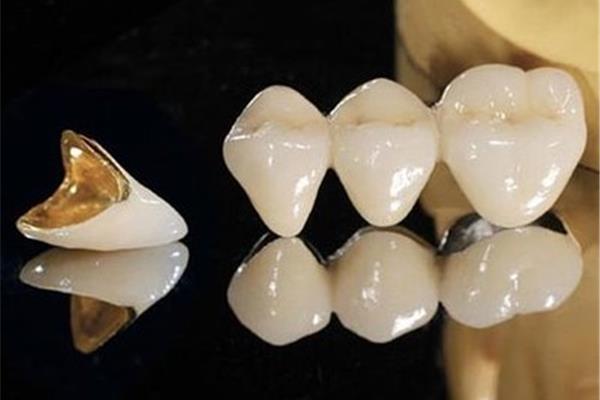 根管充填后多久做牙套,牙套可以補牙多久?