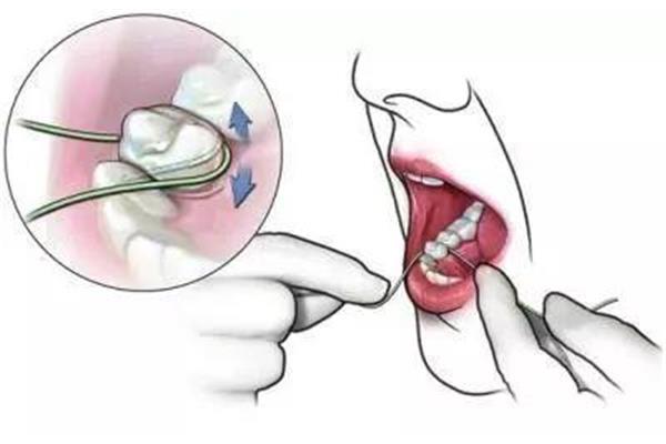 牙周炎多久能好?如何預防牙周炎復發?