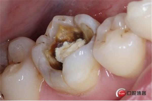 牙洞修補后能撐多久