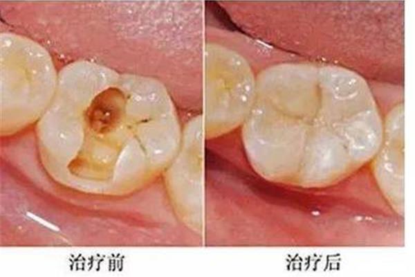 牙齒封藥后多久補牙