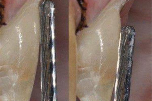 鑲固定牙能用多久
