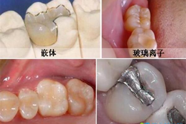 嵌體補牙能維持多久之后怎么辦