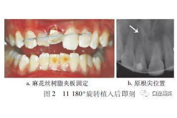 失牙再植固定后,再植固定后多長時間拔除前牙?