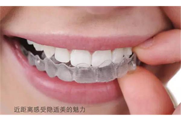 矯正牙齒需要多長時間,一般矯正牙齒需要多長時間?
