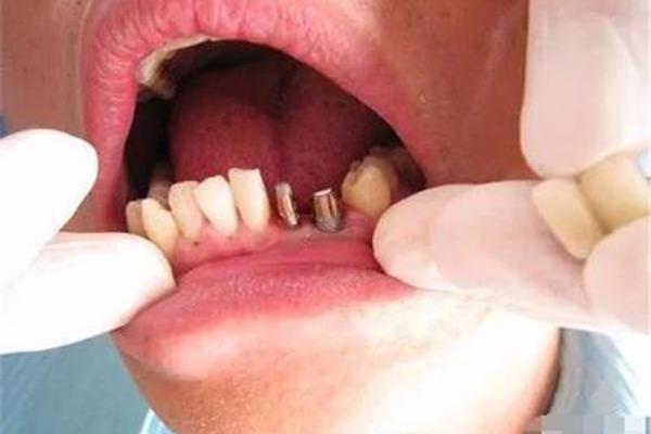 從拔牙到種植牙結束需要多長時間?拔牙后多長時間種植牙比較好?