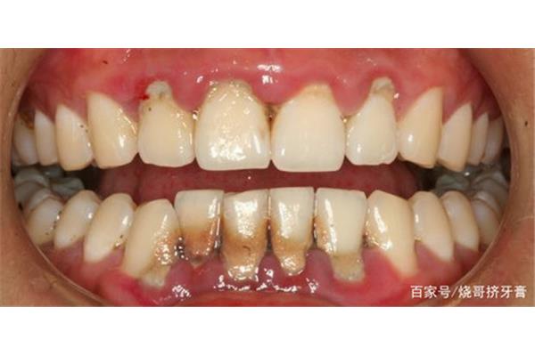 牙齒掉了多久會出現牙齦萎縮?有人牙齦萎縮到牙根嗎?