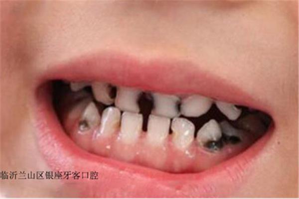 補牙后一般保質期是多久,補牙需要多久?