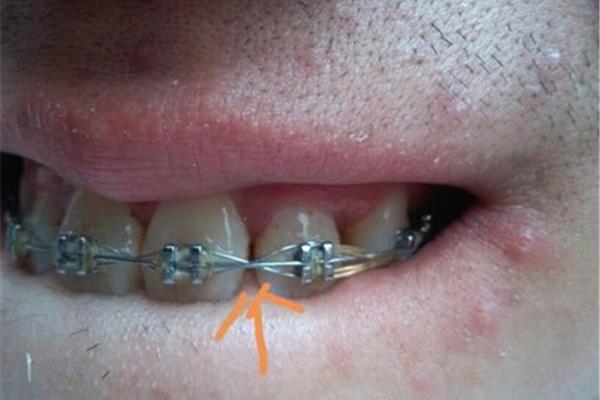 牙齒閉合后多久需要上牙套,矯正牙齒需要多久?