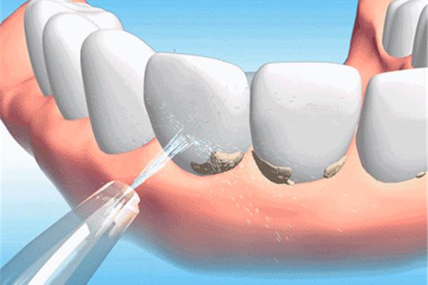 洗牙后多久可以做齦下潔治?洗牙和牙周潔治一樣嗎?