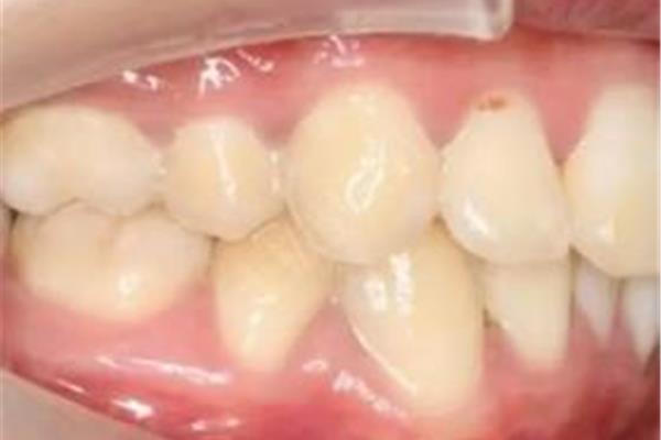 有根管的牙齒能堅持多久,有根管的牙齒能堅持多久?