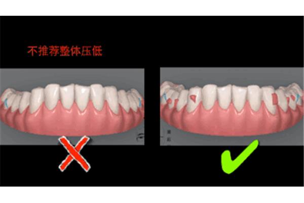 牙齒矯正要多久才能壓低牙齒?拉長牙齒壓低要多久