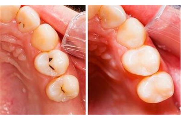 牙齒補完可以用多久,補完可以用多久?