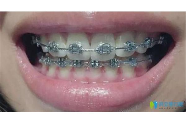 隱形牙套多久有效果,鋼絲牙套多久有效果?
