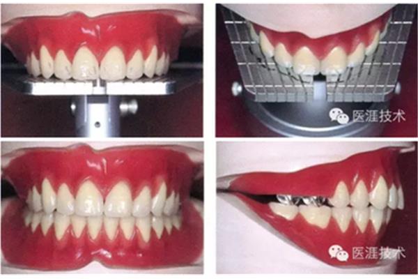 拔完牙可以做多長時間的臨時假牙,拔完牙可以帶多長時間的臨時牙?