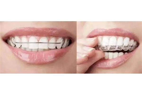 牙齒矯正多久會停止反彈,矯正后會反彈嗎?