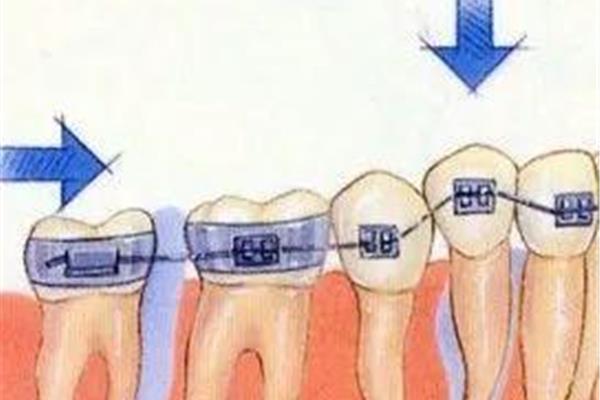 拔牙后需要多長時間閉合牙齒,拔牙后需要多長時間集齊四顆牙齒?