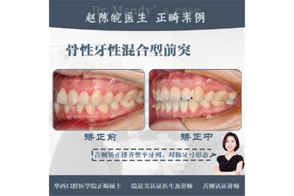 杭州矯正牙齒要多少錢?杭州哪家醫院矯正牙齒好?