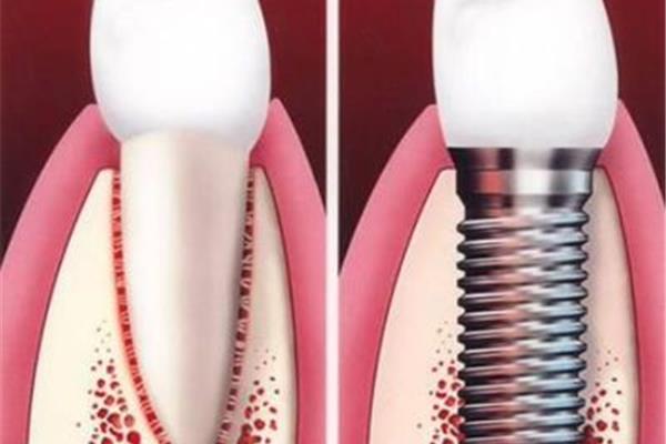 牙根外露的牙齒能用多久,牙根吸收的牙齒能用多久?