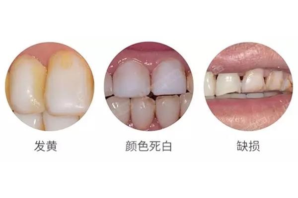 什么是瓷貼面修復?牙齒貼面一般能用多久?