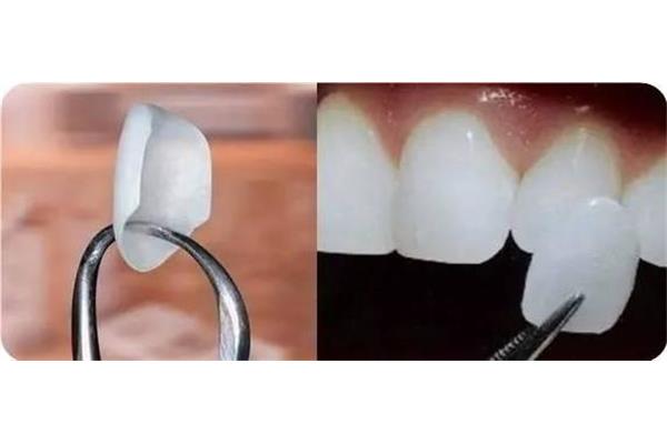 樹脂補門牙縫能用多久