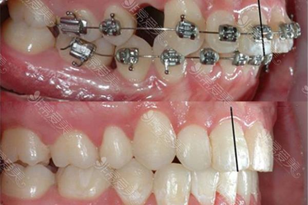 牙齒矯正后多久可以拔,矯正多久能看到效果?