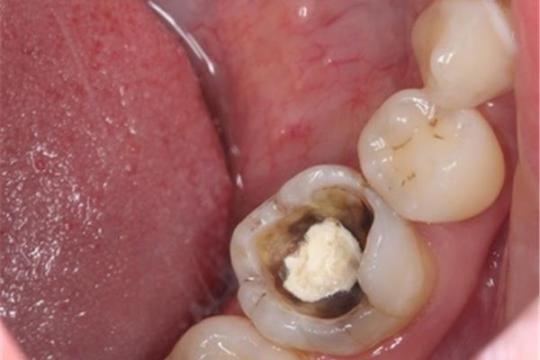 牙齒嵌體能吃多久,補完嵌體能吃多久?