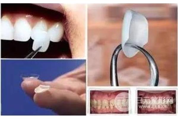 牙齒貼面可以用多久