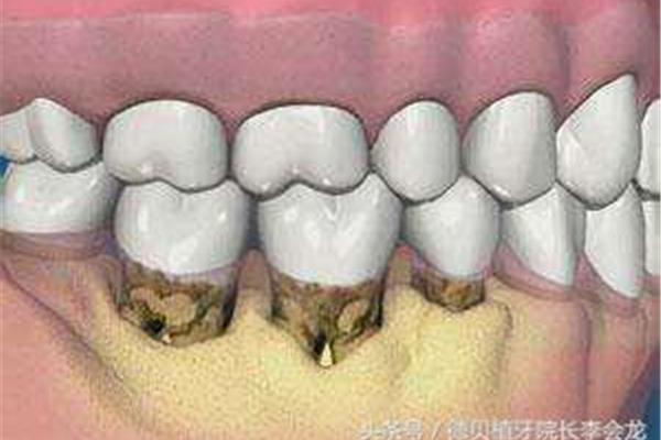 斷牙需要多長時間才能恢復?斷牙松了怎么辦?