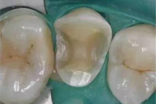 Do 嵌體可以用多久,用作嵌體的牙齒可以用多久?