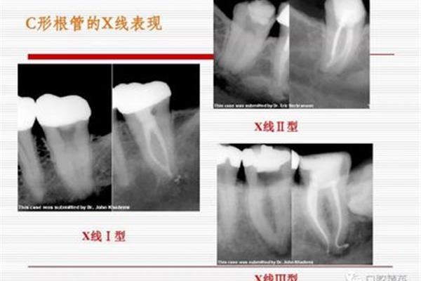 請問根管治療一般需要多長時間?關于根管、補牙和牙套