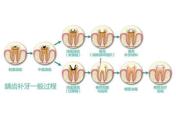 拔牙后補牙需要多長時間?杭州上城城北口腔醫院有限公司