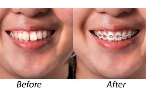 矯正牙齒要多久才能看到效果,矯正牙齒要多久才能看到效果?