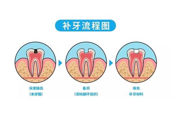 補牙過程需要多久