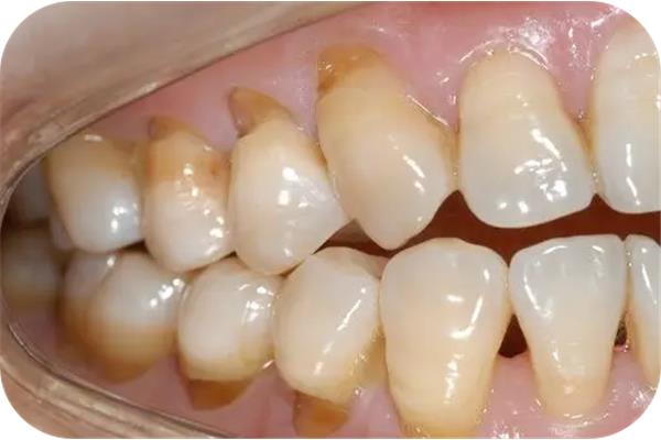 樹脂嵌體牙可以用多久