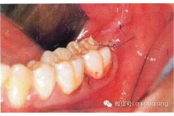 拔牙后牙齦需要多久才能長好,智齒需要多久才能愈合?
