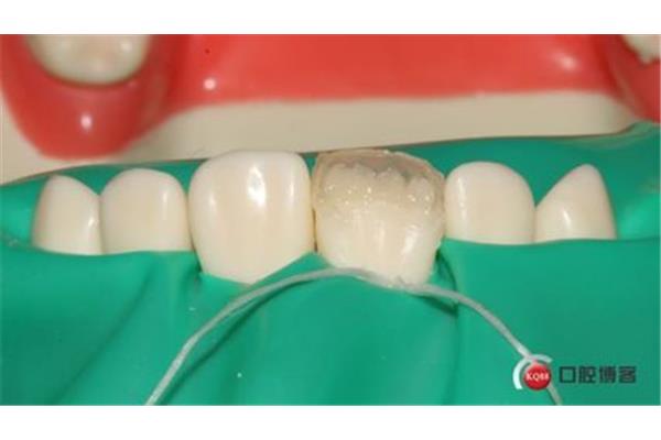 什么是種植牙的美學修復?填充物有多少種?
