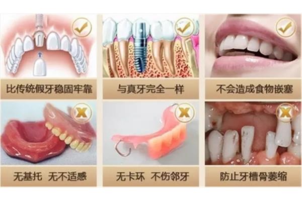 牙齒的神經多久可以修復,斷牙修復多久最好?