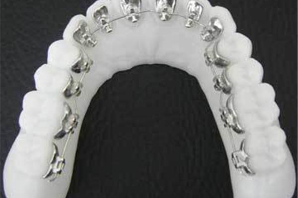 戴鋼絲牙套和正畸鋼絲需要多長時間?