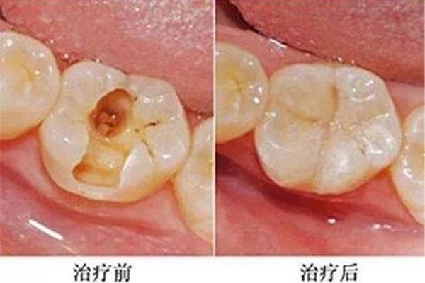 牙洞修補后能撐多久
