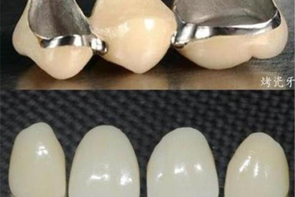 在上海補一顆牙需要多長時間?補牙需要多長時間?