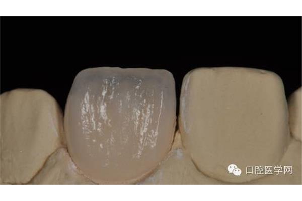氟斑牙烤瓷貼面能維持多久,做瓷貼面要多久?