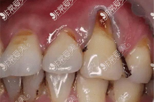 牙齒打樁鑲牙要多久次,完整根樁和種植牙的圖片