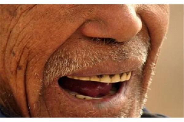 老年人掉牙后多久可以補牙?