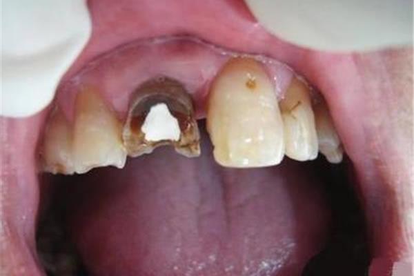 門牙死髓能用多久